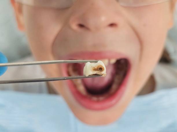 Best Emergency Dentist for Knocked-Out Tooth in Monroe, NC